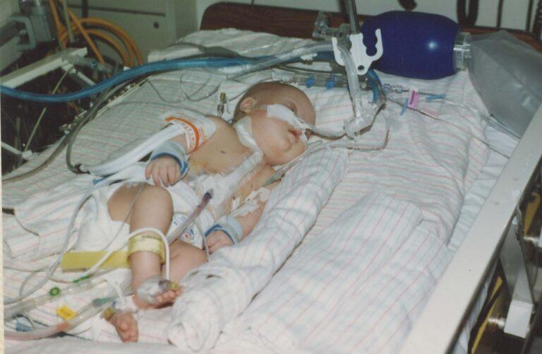 Baby girl with Down Syndrome after having open heart surgery